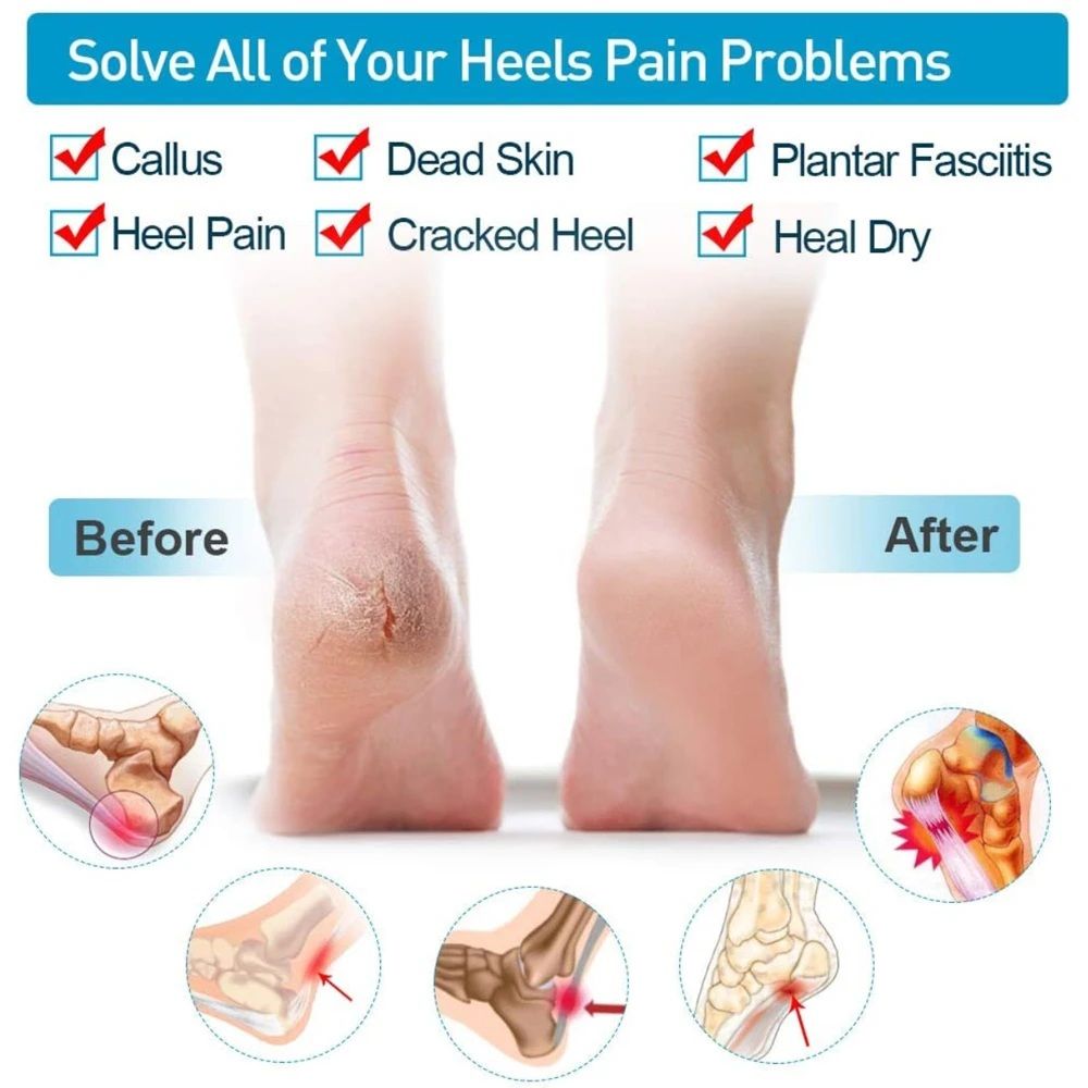Pair of Anti-Crack Silicone Heel Protectors – Pain Relief Half Heel Pads for Cracked Heels (Unisex)